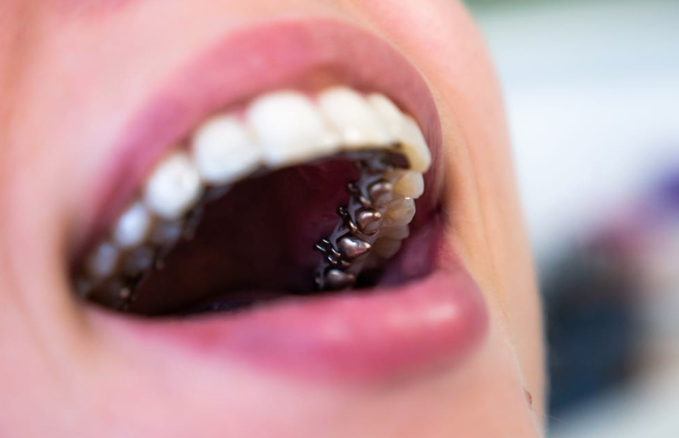 Adult Braces