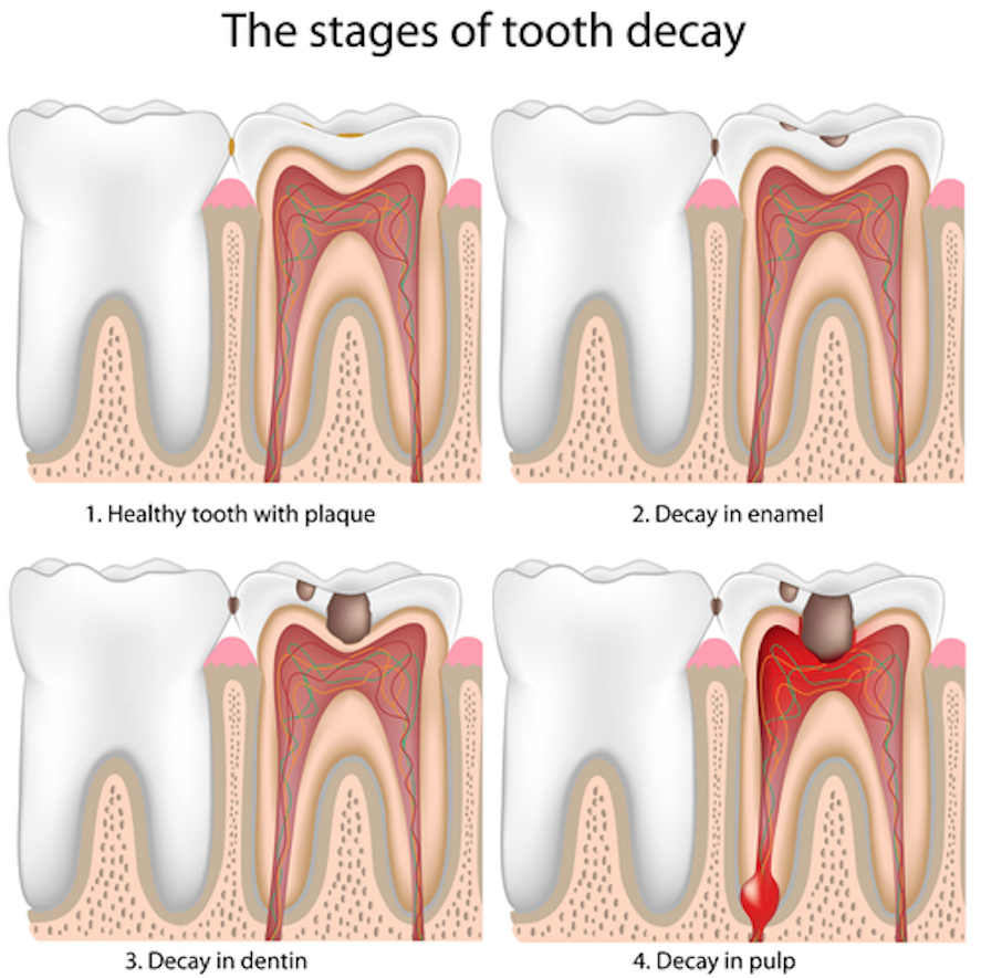 Cavity Repair