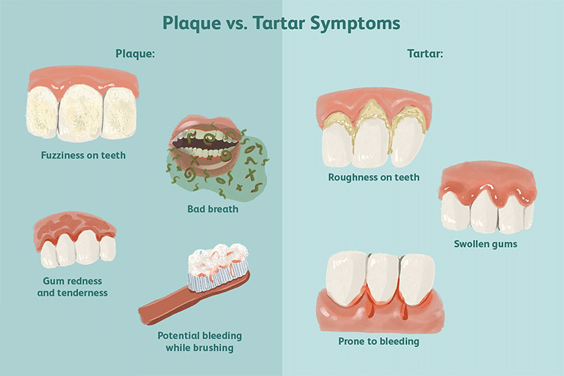plaque removal