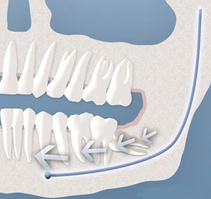 Wisdom Teeth Removal In Davis County
