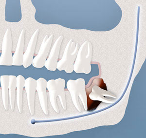 Wisdom Teeth Removal In Davis County