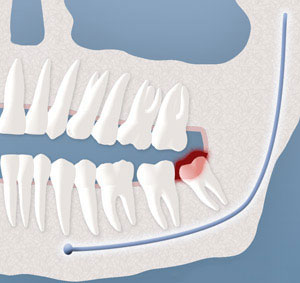 Wisdom Teeth Removal In Davis County