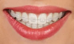 Braces in Davis County