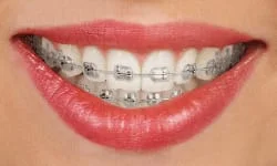 Braces in Davis County