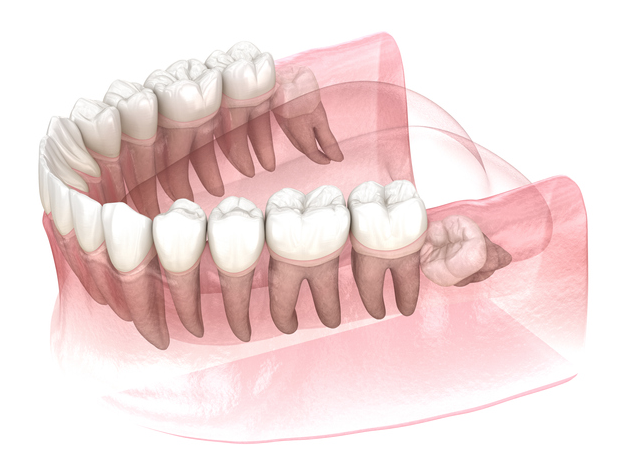 Wisdom Teeth Syracuse UT