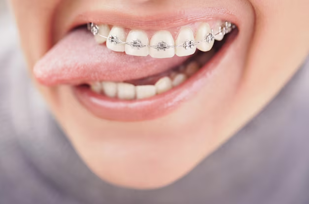 Affordable Braces